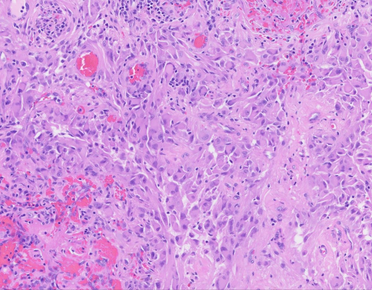 Here+is+an+image+of+a+rare+pediatric+tumor+tissue%2C+which+is+stained+purple+underneath+a+light+microscope.+The+dark+purple+dots+are+the+nucleus%2C+and+the+pale+pink+is+the+rest+of+the+tumor+cells%2C+clustered+together.+The+dark+pink+areas+are+red+blood+cells.+%28Image+Credit%3A+Mount+Sinai+Neuropathology%3B+used+by+permission%29