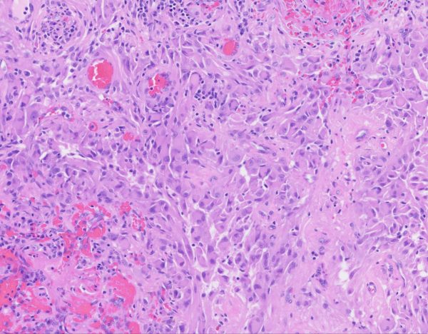 Here is an image of a rare pediatric tumor tissue, which is stained purple underneath a light microscope. The dark purple dots are the nucleus, and the pale pink is the rest of the tumor cells, clustered together. The dark pink areas are red blood cells. (Image Credit: Mount Sinai Neuropathology; used by permission)