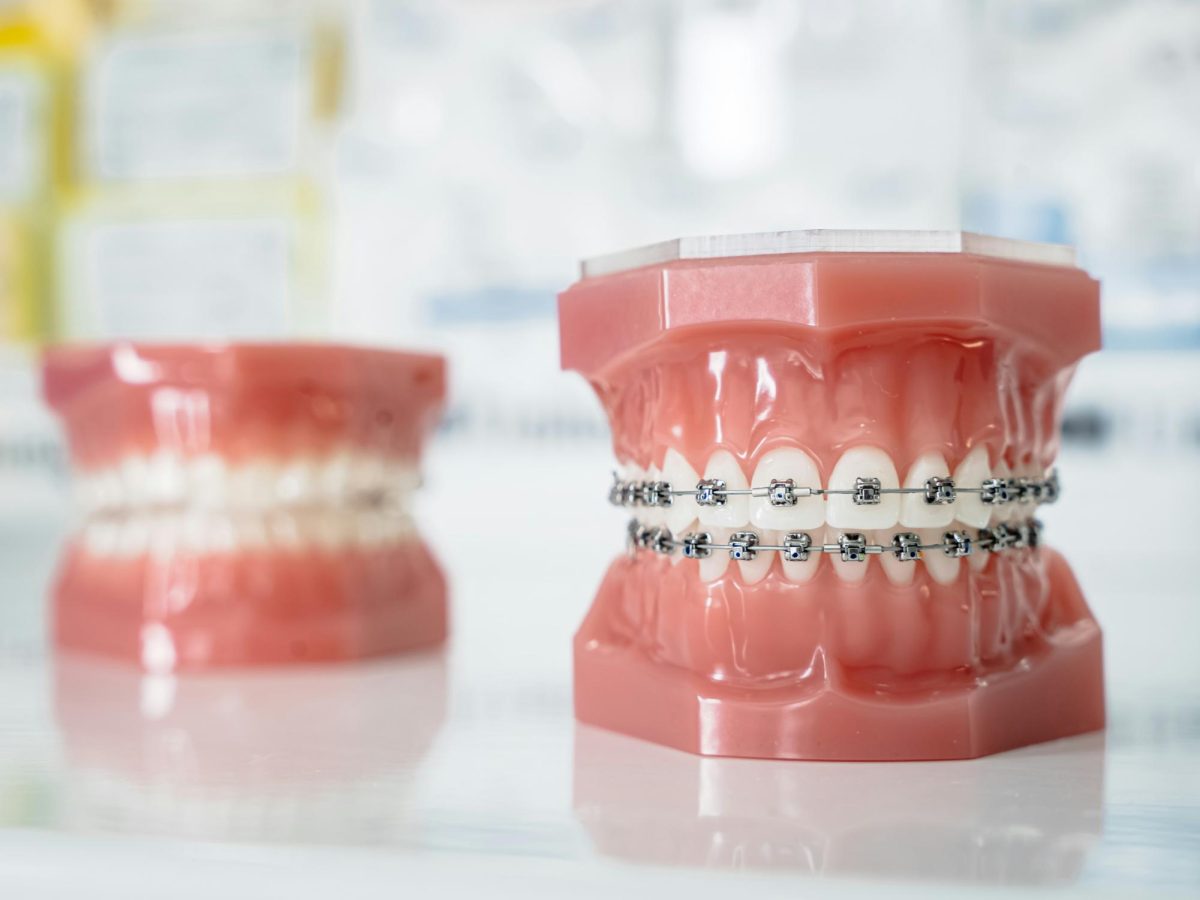 Although every smile is unique, most people opt for braces in order to attain straight teeth. Straight teeth allow for more confidence, style, and sometimes a better look. (Photo Credit: Katarzyna Zygnerska / Unsplash)
